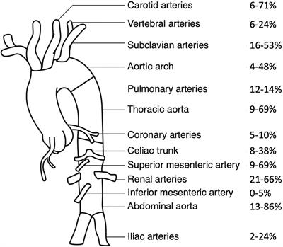 An Update on Childhood-Onset Takayasu Arteritis